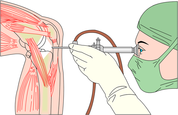 Arthroscopic
