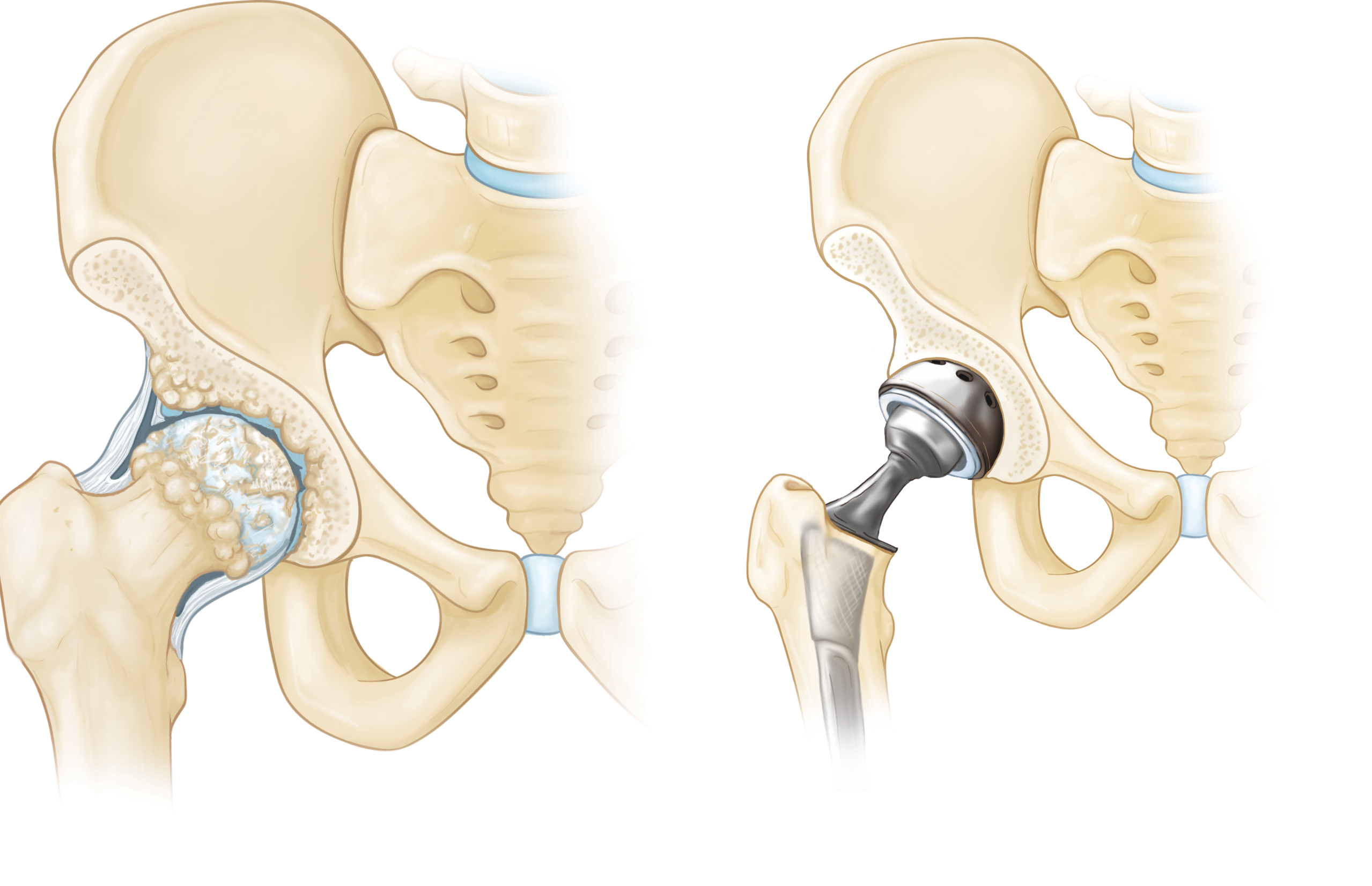 joint-replacement